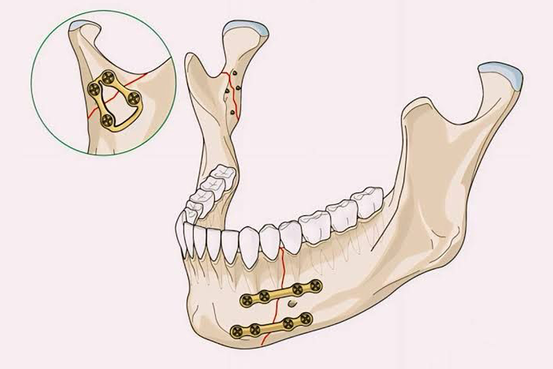 Road traffic accidents (RTAs)